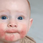 bebeklerde alerji belirtileri