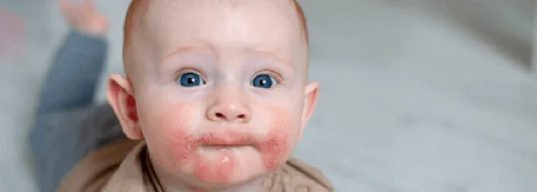 bebeklerde alerji belirtileri